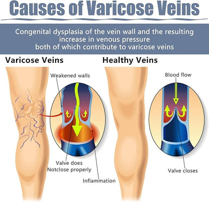 🦵 Parche Alivio Varices – Ligereza y Bienestar para tus Piernas 🦵